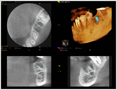 今福鶴見ノア歯科クリニックの歯科用CTによる画像診断